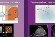 Photo of Эластография сдвиговой волной на УЗ-аппаратах: новейшие технологии в медицине